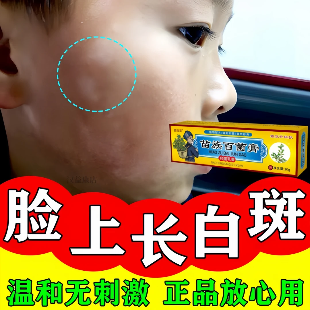 白色糠疹儿童桃花藓脸上长癣白斑小孩汗斑皮肤【祺洲】瘙痒苗方凝胶