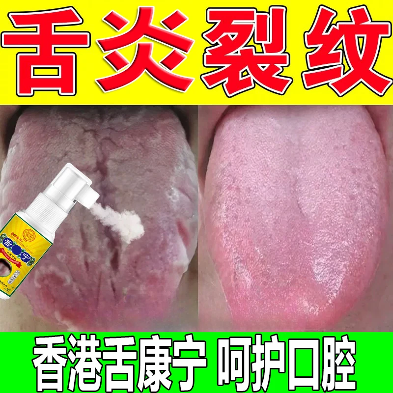 【支持试用】舌头起泡舌苔厚舌裂麻木舌头痛裂舌地图舌口腔抑菌喷剂