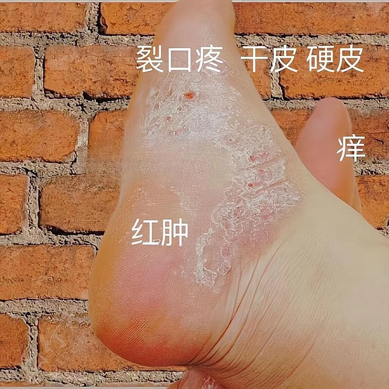 /夫洁美宝脚痒脱皮脚背痒开裂脚臭脚红肿脚痒红肿脱皮软膏