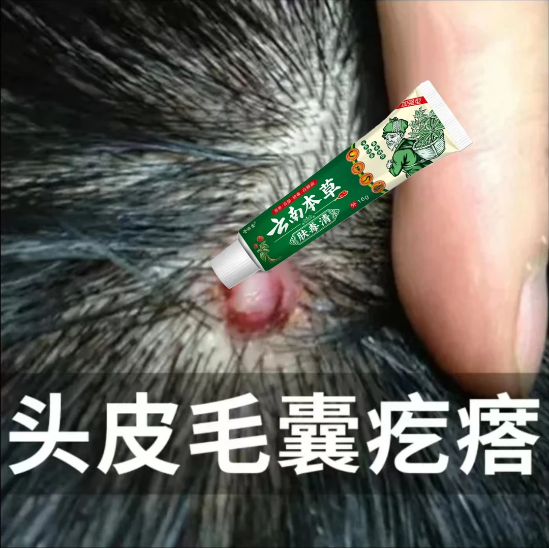 头皮痒头皮起疙瘩头皮小红痘痘头皮红疹头上毛囊堵塞脓包软膏