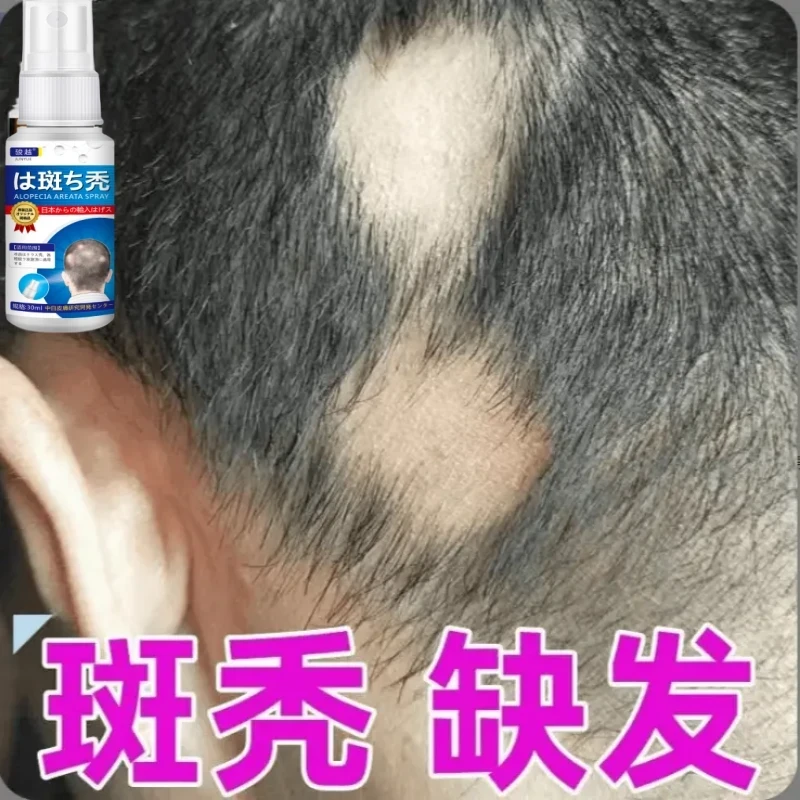 外用鬼剃头喷剂日本斑秃压力熬夜脱发秃头谢顶专用涂抹草本喷雾