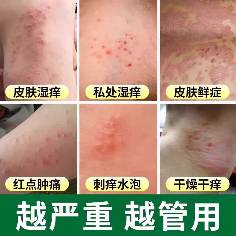 【狼毒真菌王】牛皮廯肤顽固手足体股廯红点止痒大腿内侧痒外用乳膏