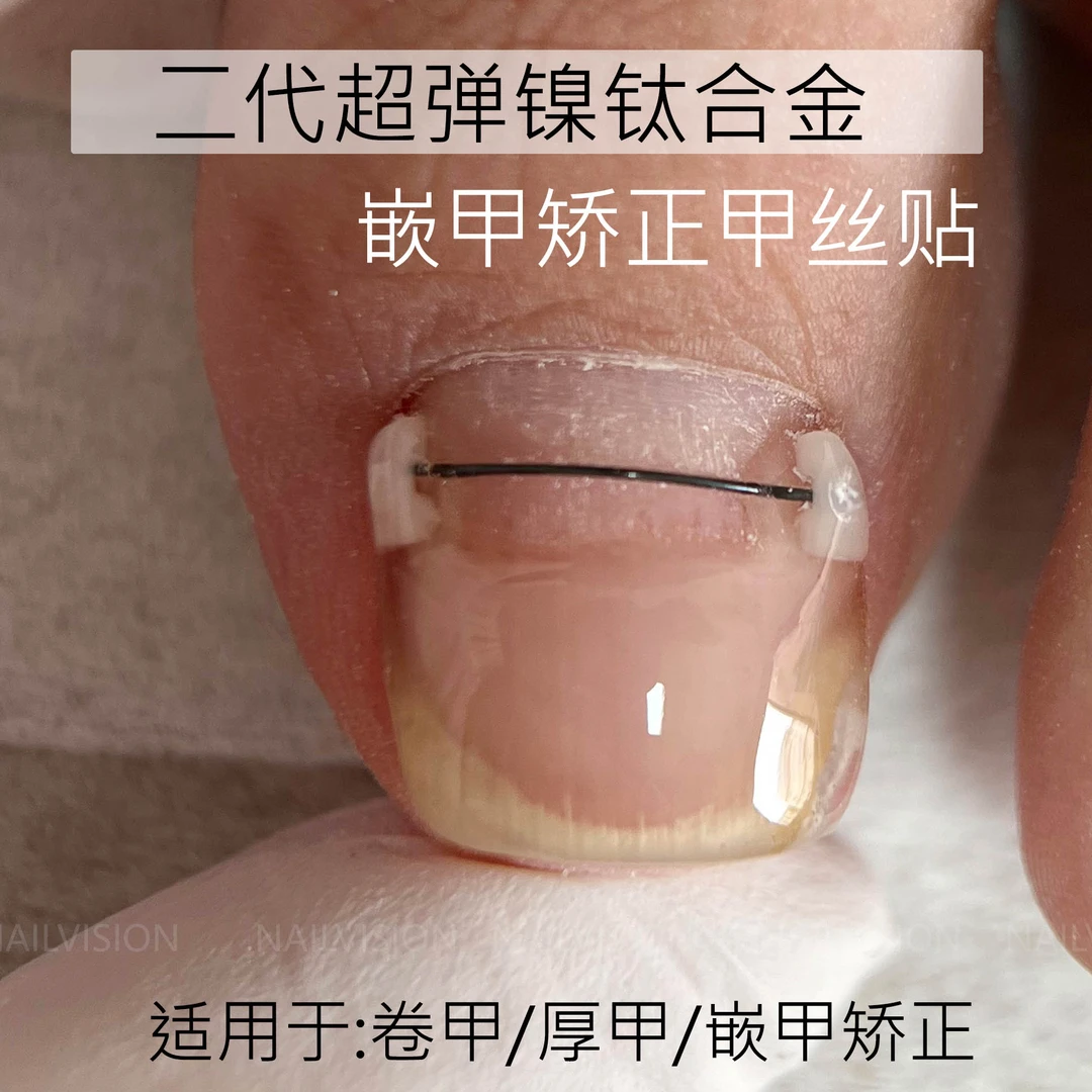 镍钛合金甲丝钢丝牵引丝脚趾甲扎肉卷甲厚甲嵌甲矫正神器