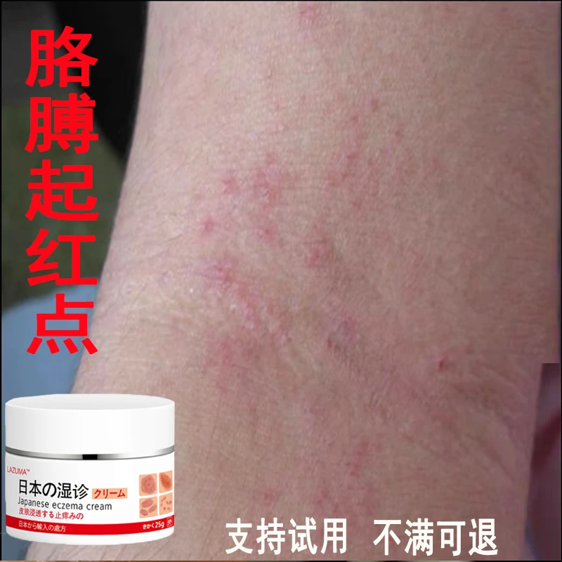 【日本湿诊膏】皮肤皮肤外用抑菌膏草本涂抹手脚起水泡大腿止痒乳膏