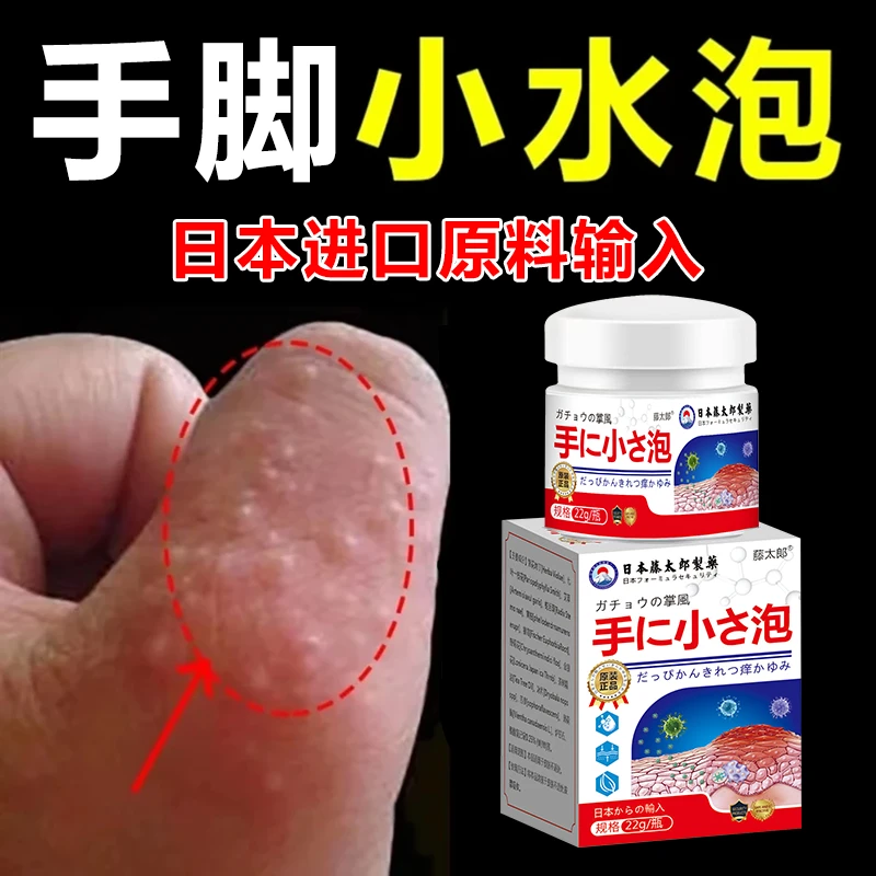 手上起小水泡外用涂抹手指手缝红痒渗液脱皮止痒清凉护理草本乳膏