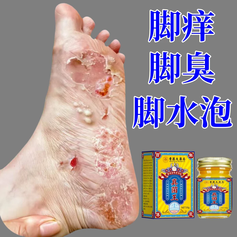 【官方正品】脚痒脚臭香港脚脚趾缝痒脱皮手足痒真菌感染真菌王