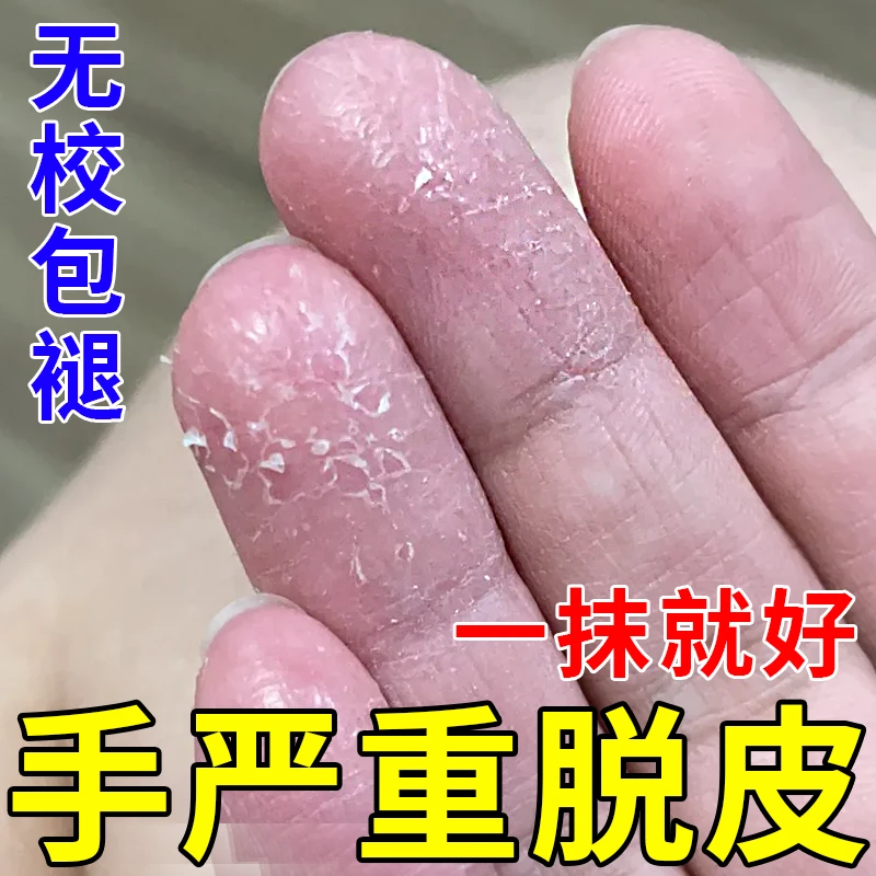 手脱皮蜕皮手指干燥起皮手指手掌心干裂手爆皮裂纹掉皮止痒抑菌膏