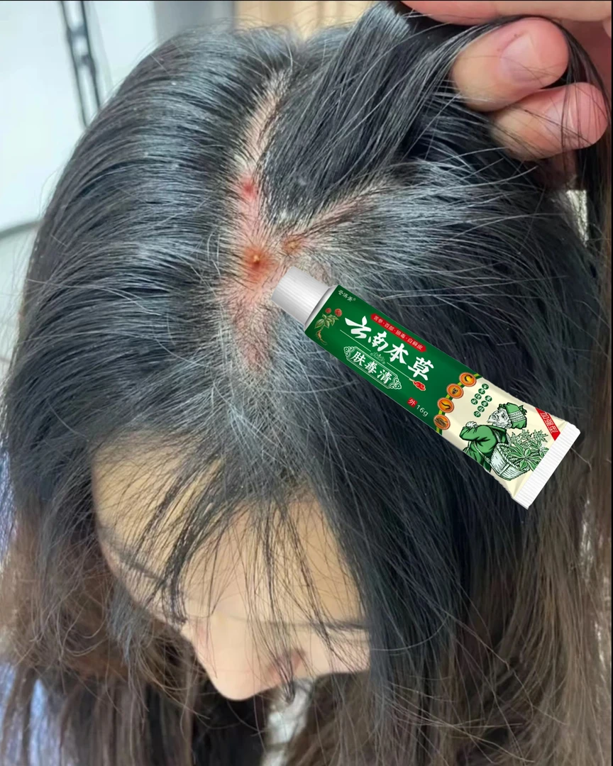 头皮祛痘去背部胸前胸口身体背上长有痘痘除螨虫硫磺痘印神器软膏