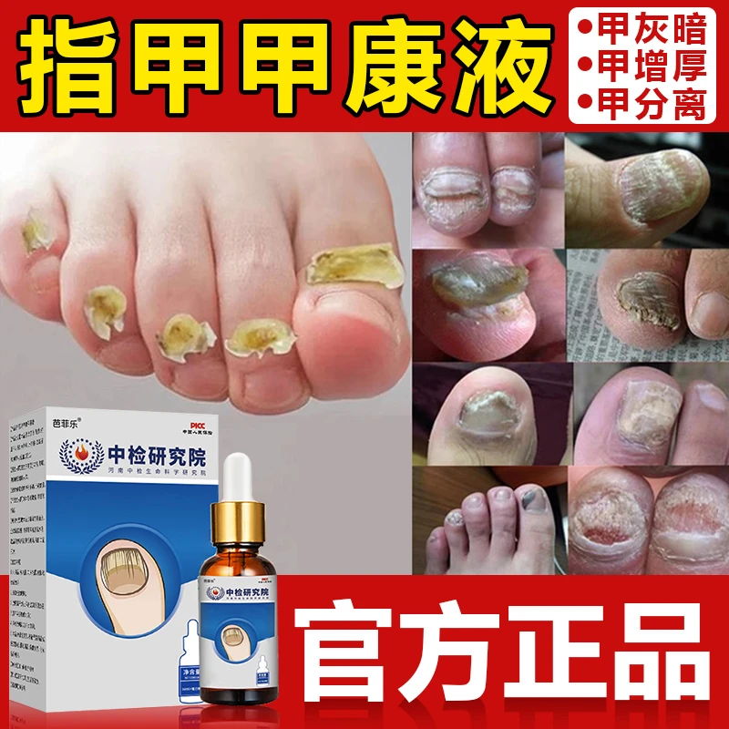 脚趾甲专用液正品水凤仙花指甲手指脚趾甲变灰色