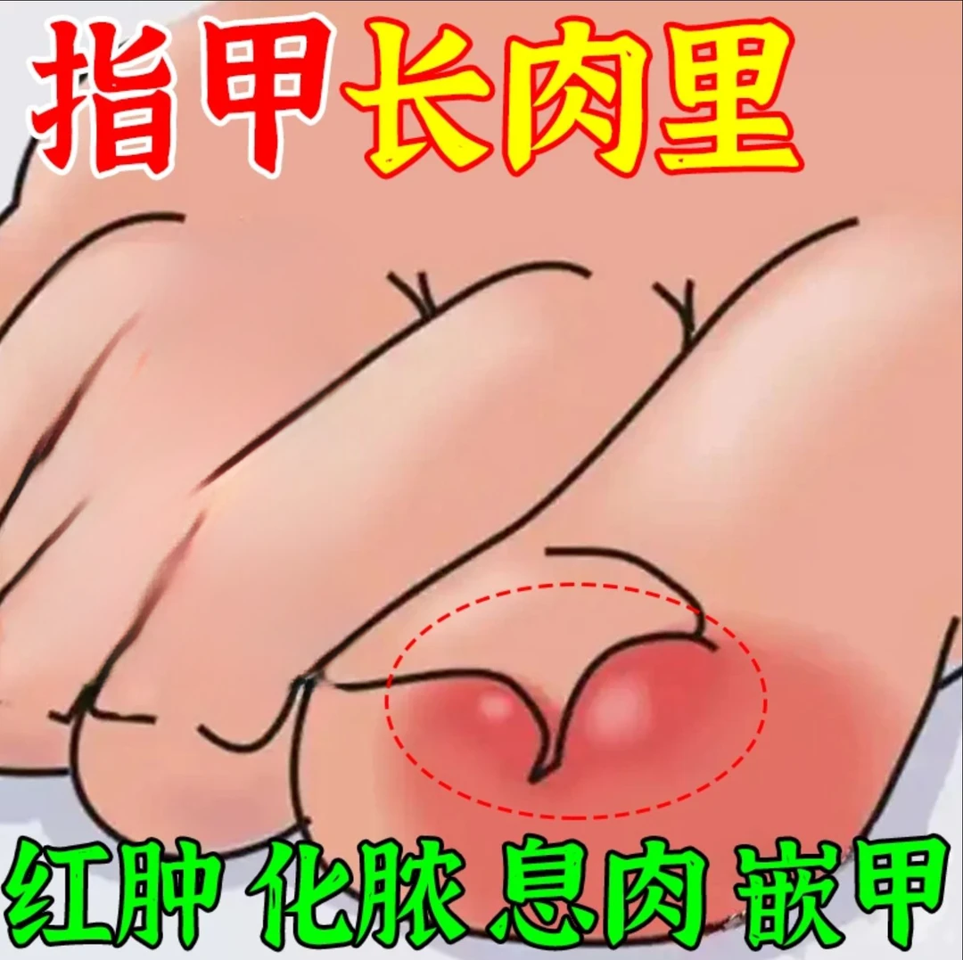 指甲长肉里甲沟肿大有脓包软甲脱甲脚指甲化脓脚趾头甲沟液