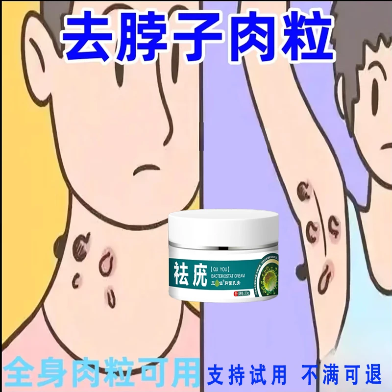 【小肉粒专用】香港华春百草快速克尤神器脖子手足腋下丝状扁平肉刺