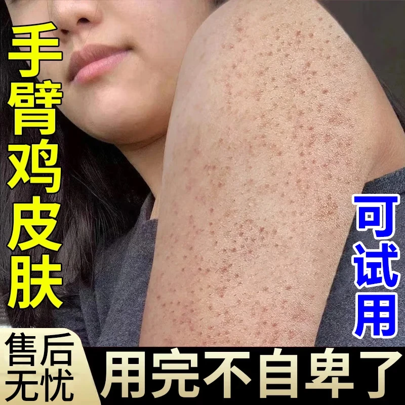 鸡皮肤疙瘩毛囊角化 大腿手臂毛孔堵塞皮肤干燥粗糙 乳膏xx