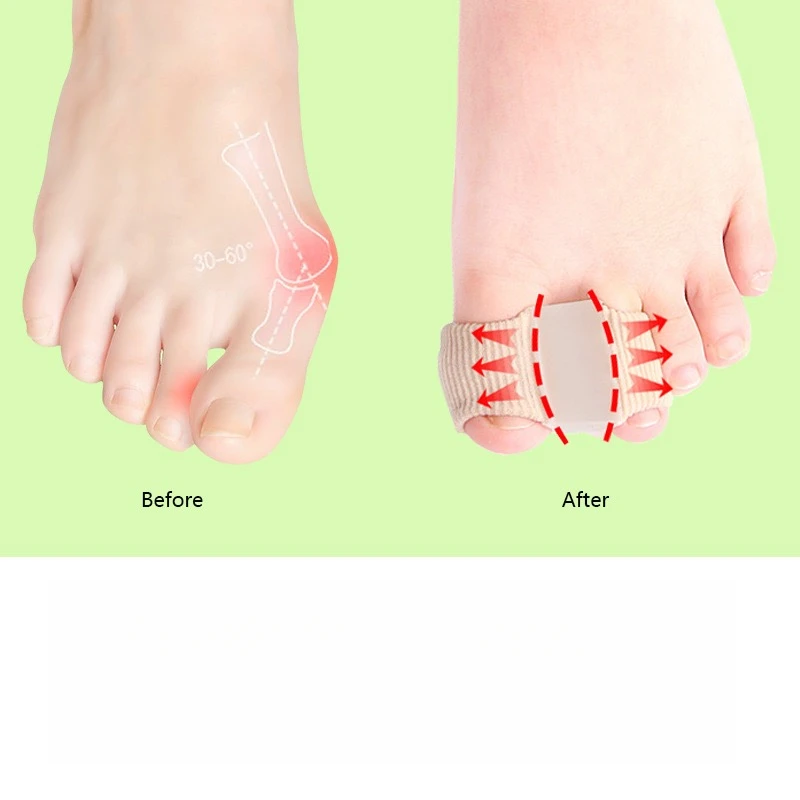 聚鑫//三代新款脚趾分扯器 足部硅胶防护套 可穿鞋