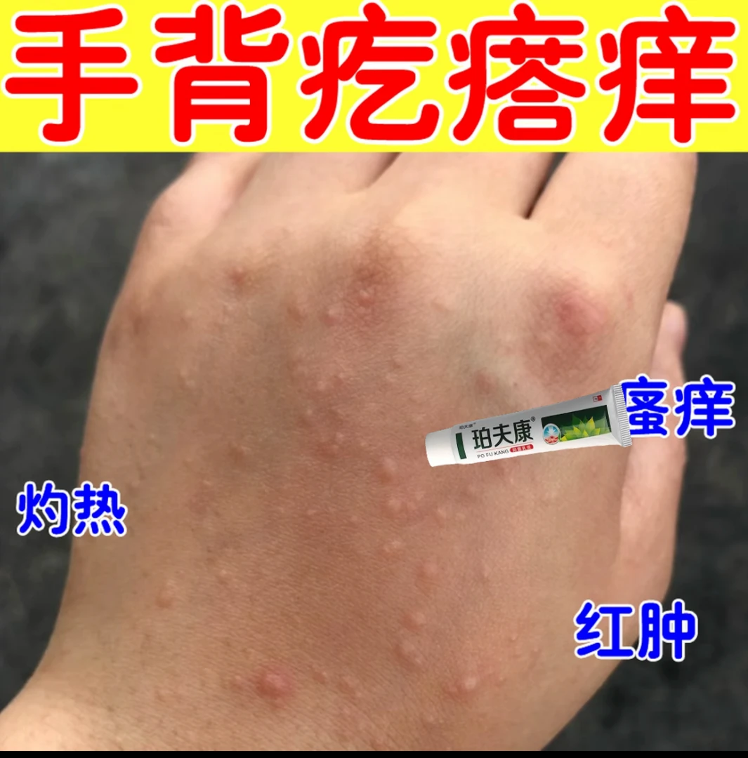 手指长小水泡手部痒手足脱皮手指开裂手指脱皮手足起汗泡抑菌软膏