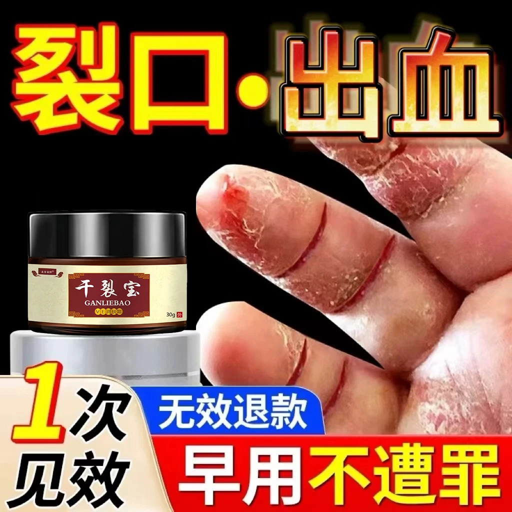 手指头裂口子干裂修复护手霜开裂脱皮裂开手足开口手脚出血严重夫