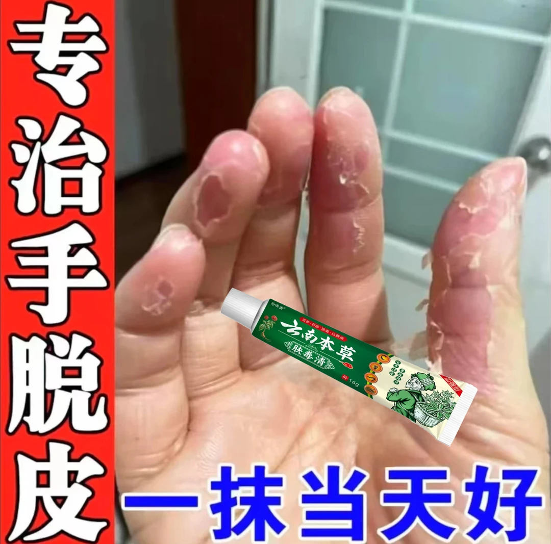 鹅掌风手部干裂脱皮手痒手裂口子手足开口开裂起皮草本膏