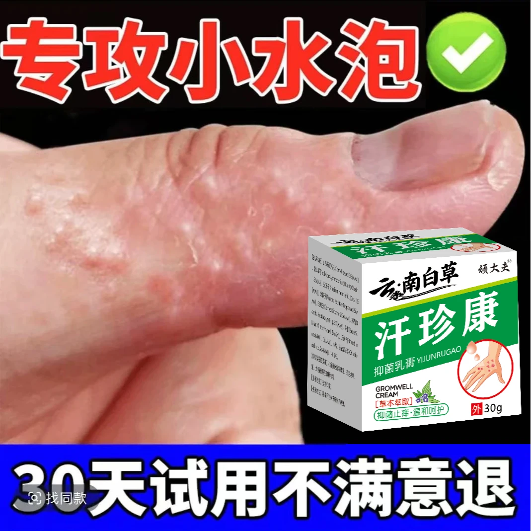 汗珍泡手上起小水泡止痒膏脱皮抑菌克星手指缝痒干裂专用草本乳膏