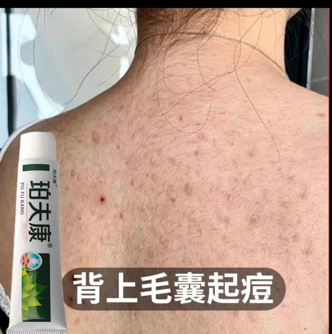 后背毛囊痘痘身体背上胸前脖子头皮止痒皮肤抑菌外用喷剂男女通用
