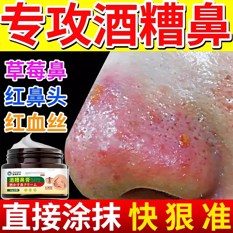 吉雅藤耐酒糟鼻膏 鼻子红肿毛孔粗大红血丝不适涂抹保健膏批发