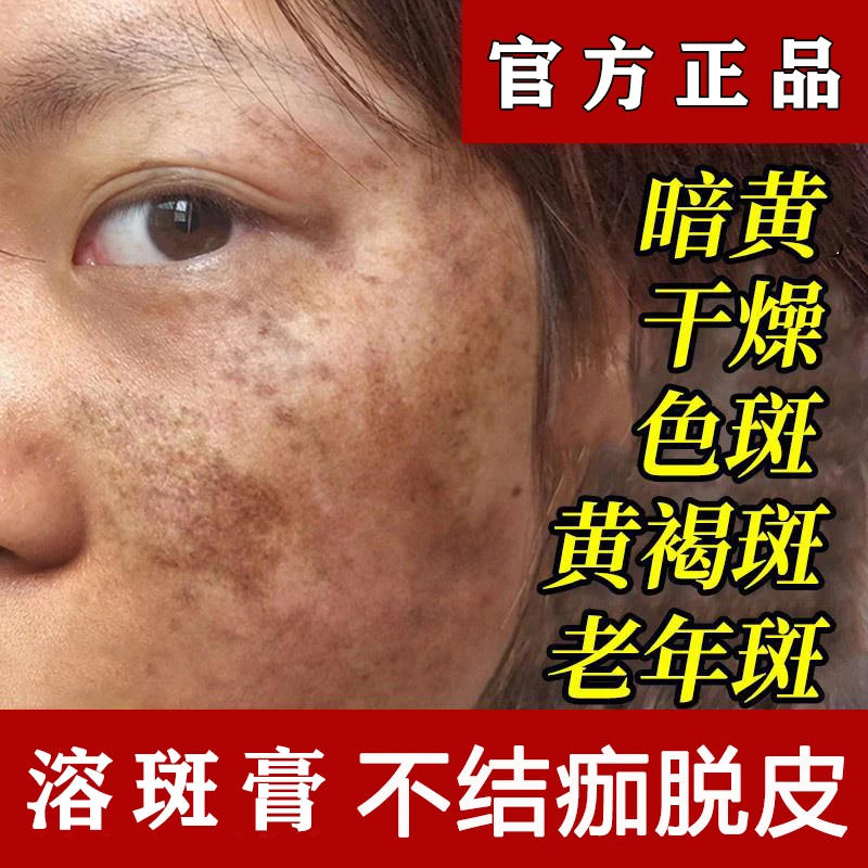 官方正品溶斑膏不脱皮淡斑精华液美容院去雀斑晒斑黄褐斑真皮