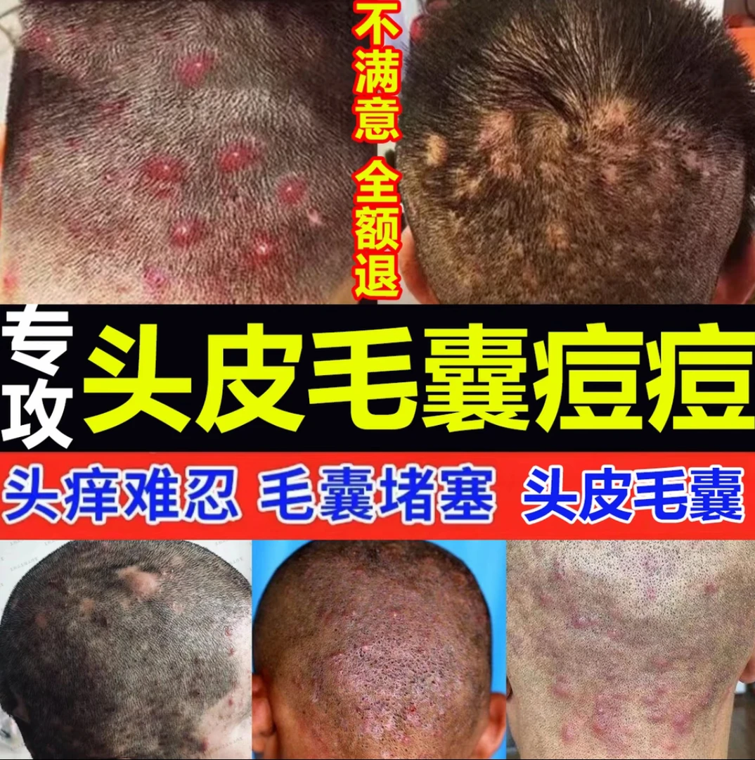 头皮毛囊头起长小红圪塔脓包头屑痘痘头部特效专用止痒乳膏