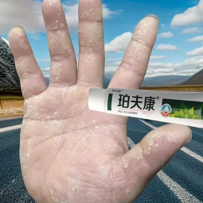 手指长小水泡手部痒手足脱皮手指开裂手指脱皮手足起汗泡