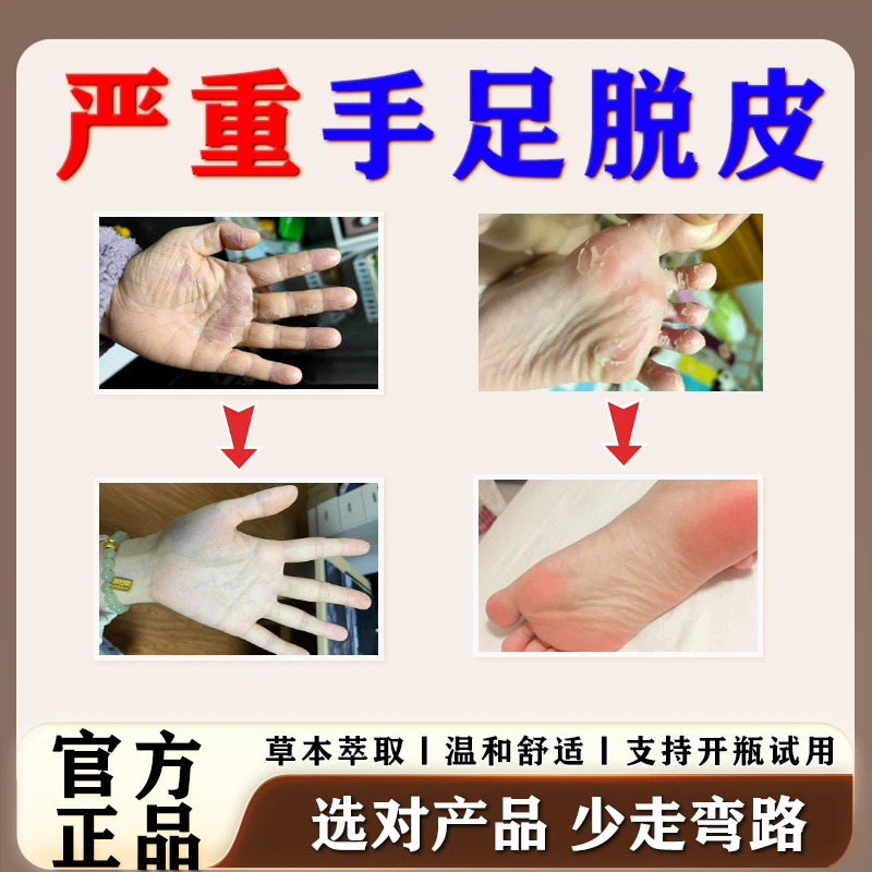 【官方正品】草本萃取手足脱皮膏