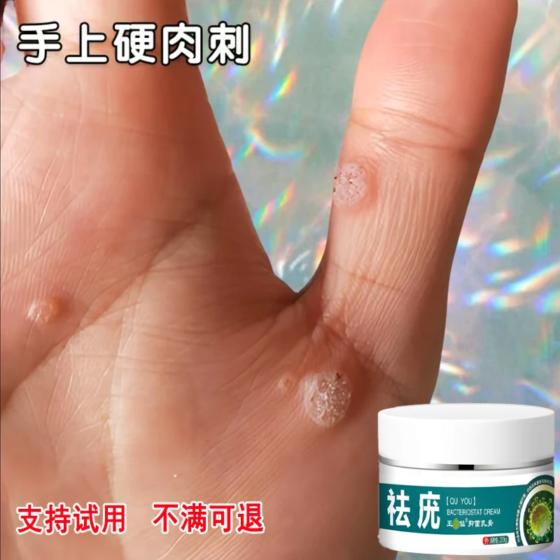 手指凸起硬肉刺扁平手足寻常疙瘩脖子腋下肉粒丝状肉钉草本涂抹膏