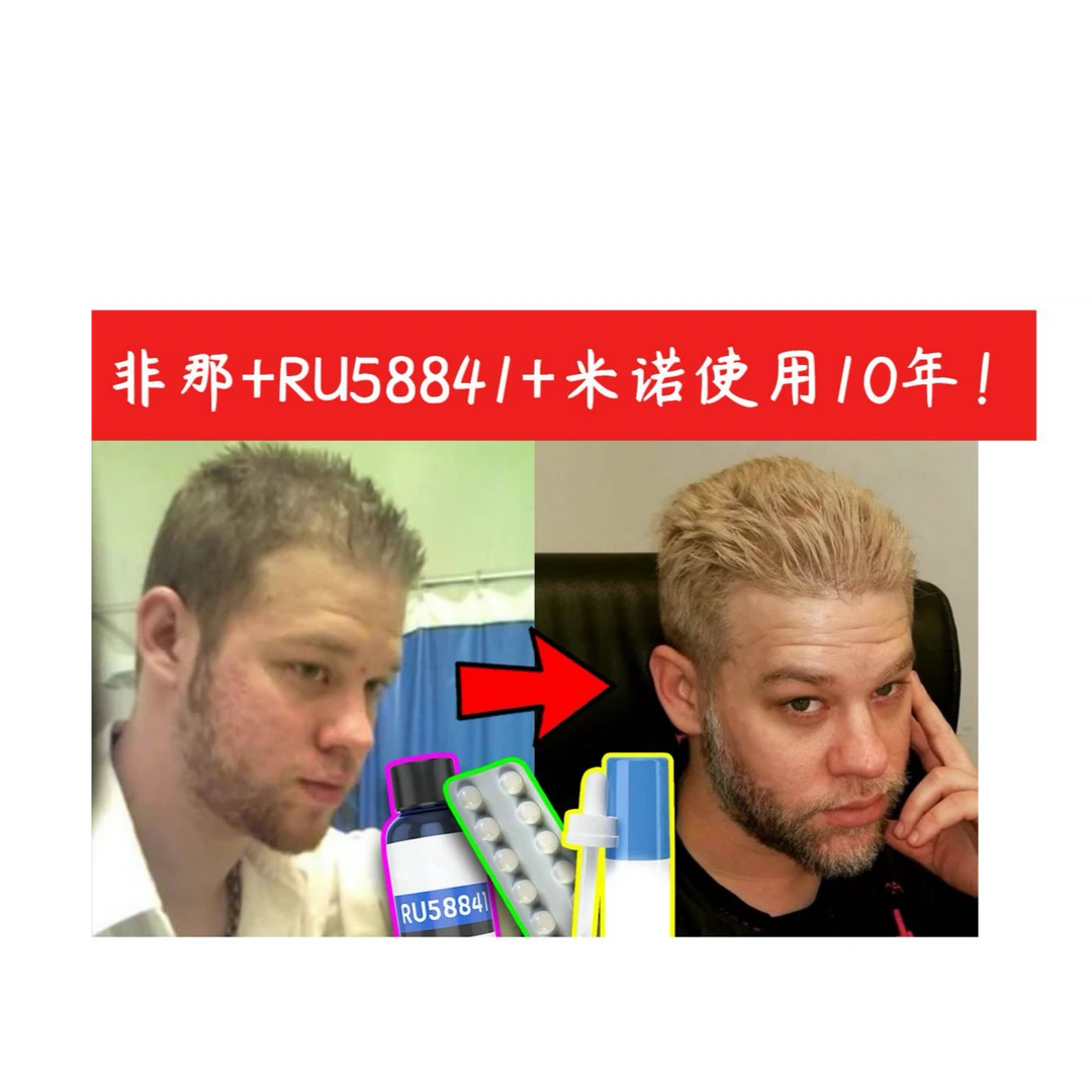 RU58841(高亲和力） 植物抗雄DHT雄脱护发RX