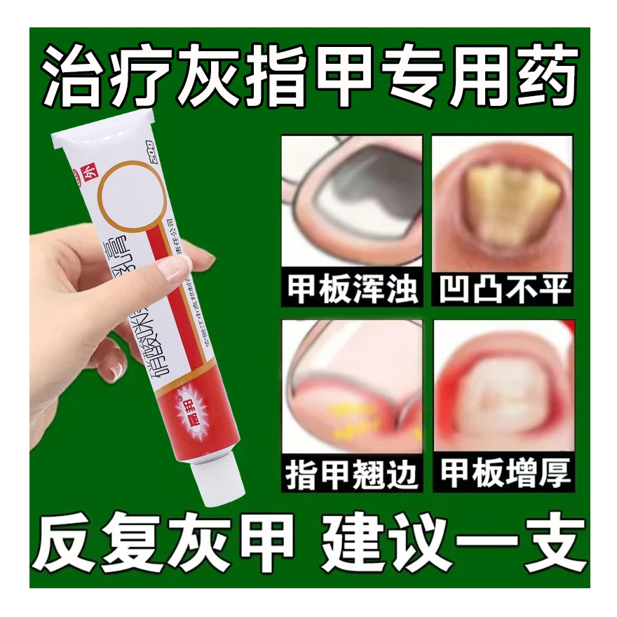 治灰指甲专用药甲板变色增厚表面凹凸不平变脆易碎甲分离甲周红肿糜烂温和去病甲灰甲甲癣真菌感染专用药高邦硝酸咪康唑乳膏2%*20g