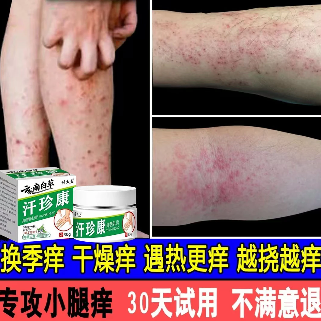 正品腿上干燥起皮小腿皮肤痒秋冬腿部瘙痒越抓越痒止痒抑菌膏