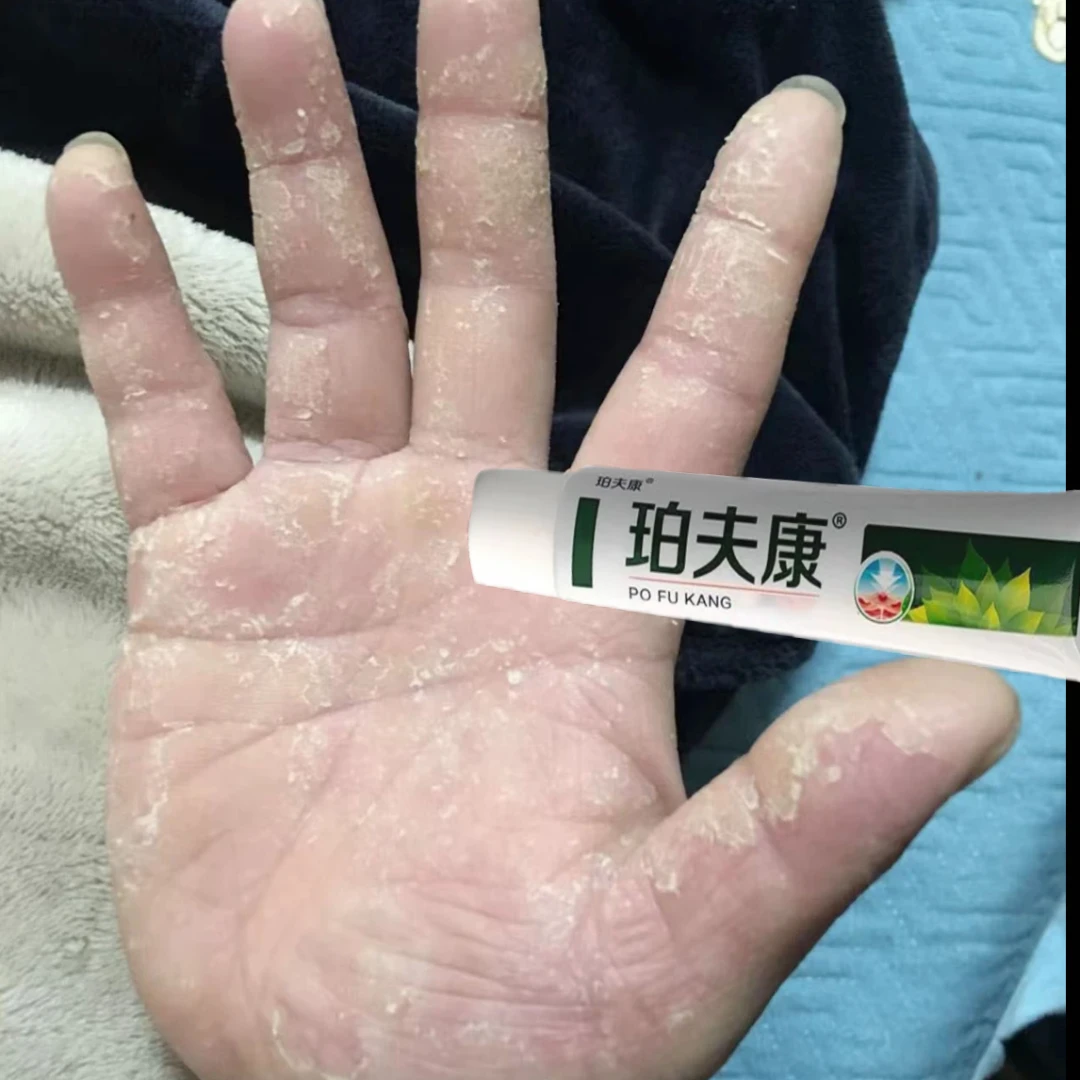 手指长小水泡手部痒手足脱皮手指开裂手指脱皮手足起汗泡