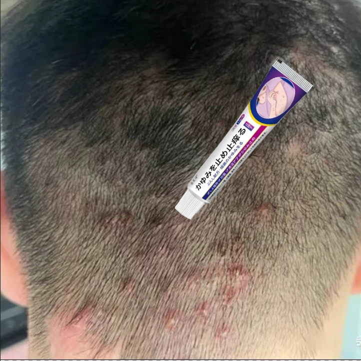 头皮起疙瘩快速湿毒痒疙瘩手脚起疙瘩个人护理温和l草本惠清通