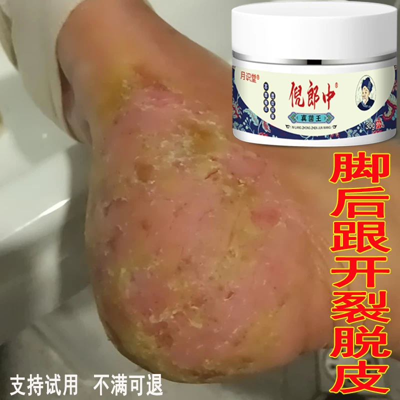 真菌王脚后跟季节性开裂神器防裂膏手足干裂痒真菌感染抑菌止痒膏