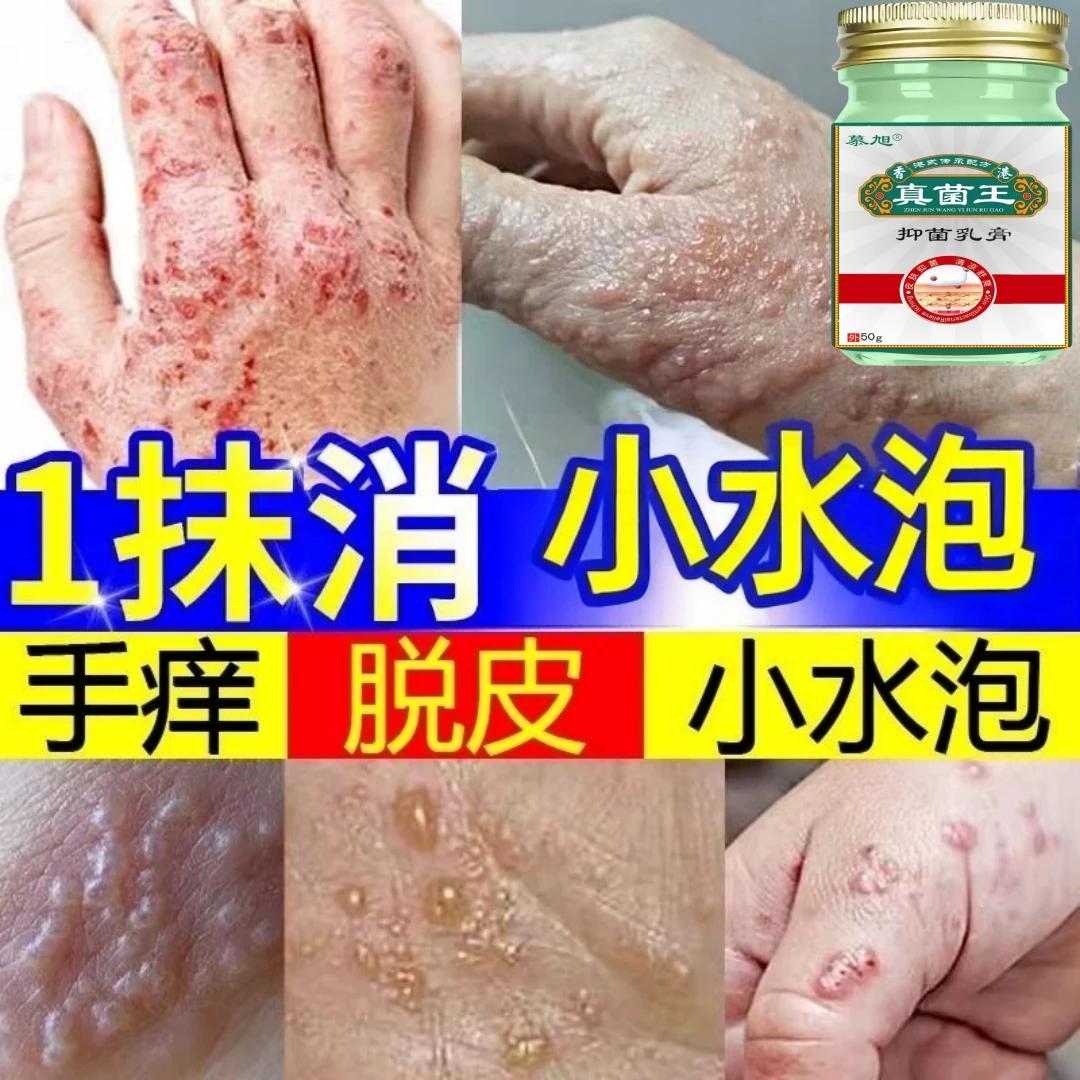 手上起小水泡止痒膏脱皮抑菌克星手指缝痒干裂汗专珍用泡真菌王