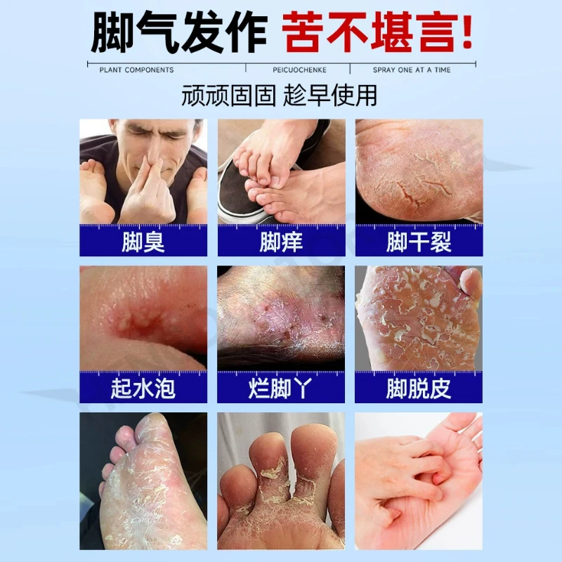 脚部糜烂脚气脚癣皮肤瘙痒脱皮脱屑红肿干裂烂脚趾缝糜烂汗脚脚臭渗液杀菌止痒曲延康医用皮肤液体敷料