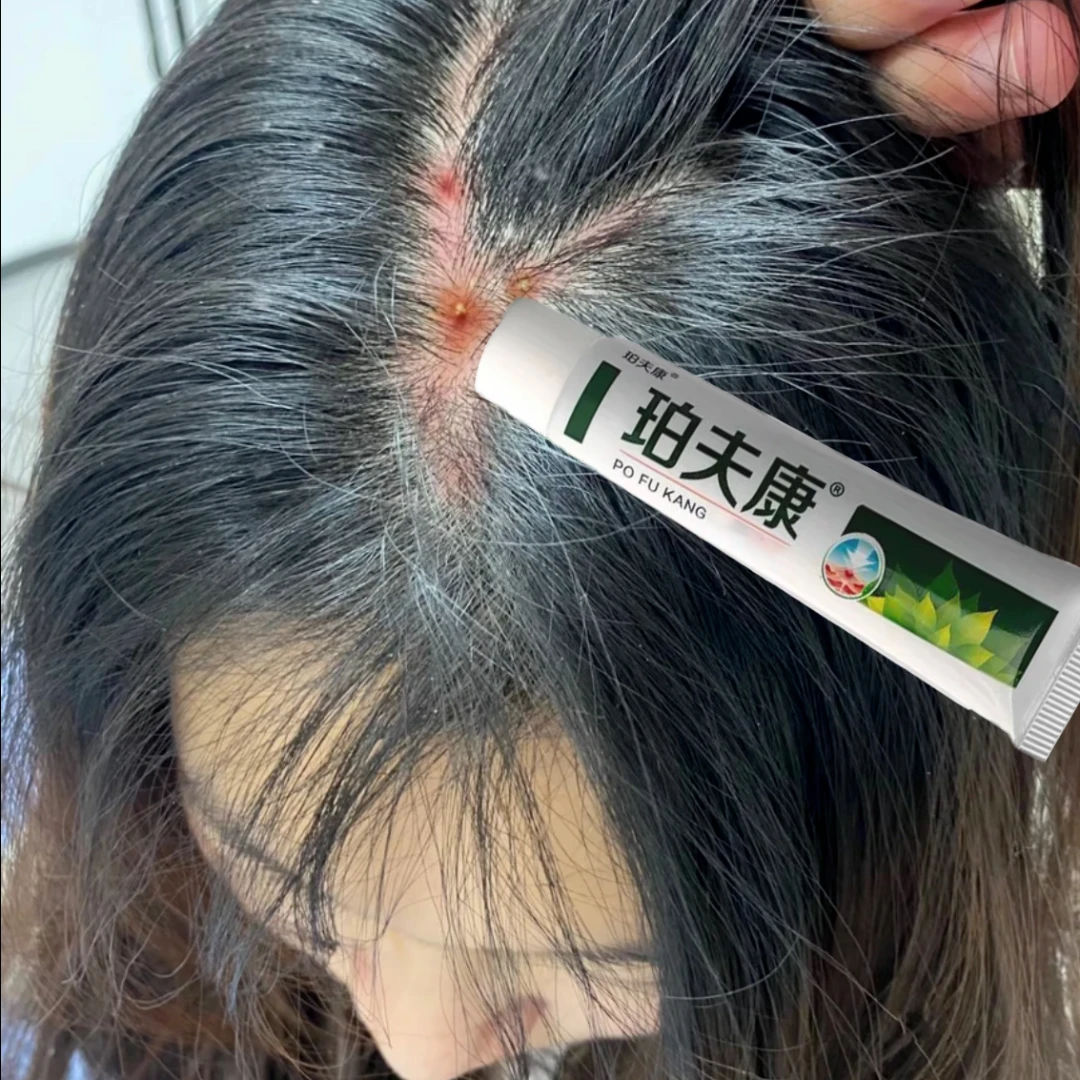 头皮疙瘩前胸后背长痘痘马拉色菌毛囊症状特效头皮小脓包怎么消除