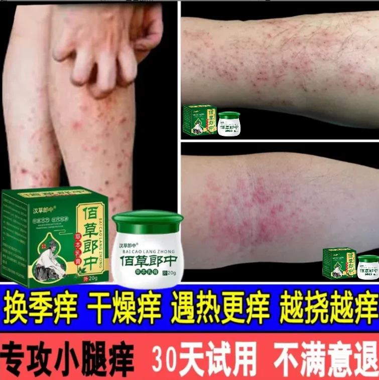 腿上皮肤干燥发痒小腿皮肤痒秋冬天腿上很痒越抓越痒止痒膏草本