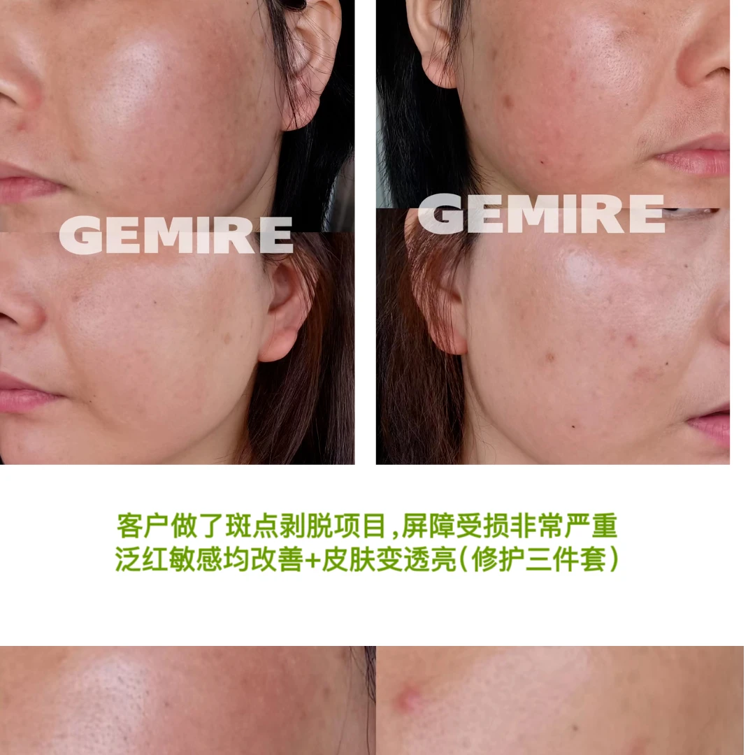 【修护三件套】绷带水+急救瓶+冰绷敏肌修护反馈对比