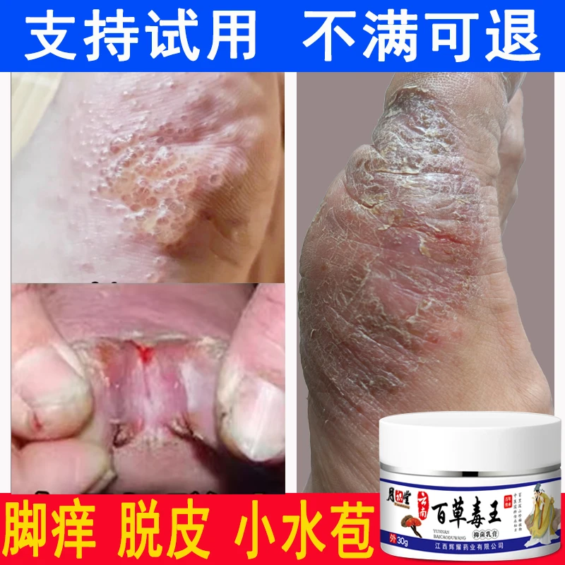 【百草膏】止痒膏脚出汗脱皮起小水苞干裂脚趾缝痒抑菌止痒清洁外用