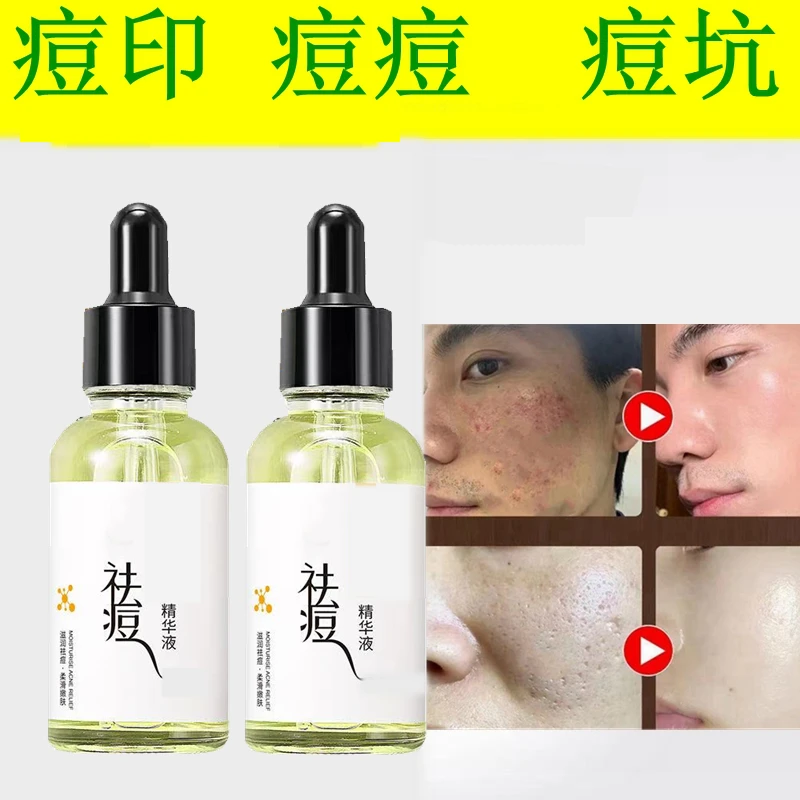 【拍一发二】快速祛痘精华原液淡化痘印痘坑修复男女士专用粉刺闭口
