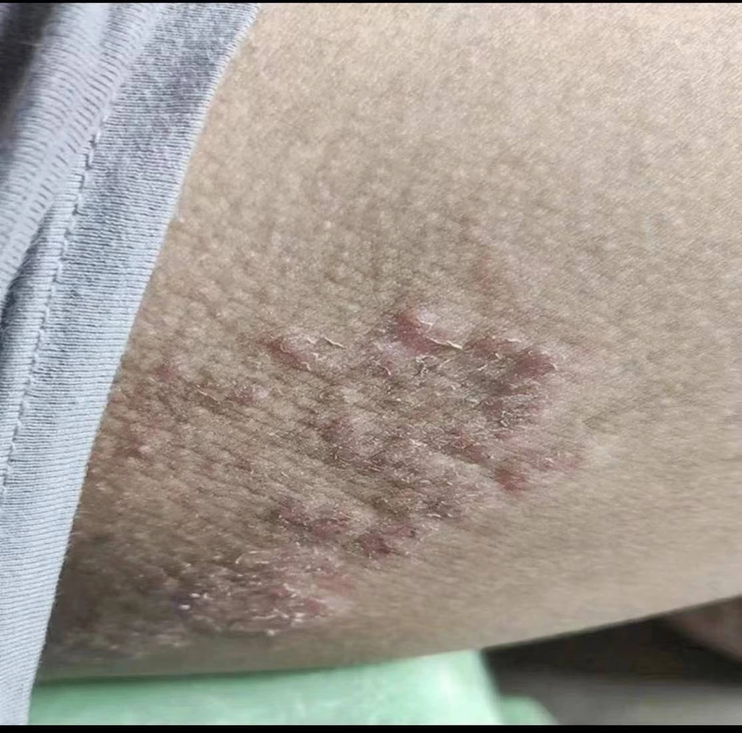 大腿两侧发黑内侧大腿痒发红磨大腿疙瘩痒常备止痒软膏草本抑菌