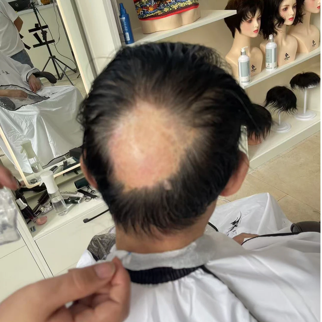 伤疤局部补发、斑秃补发真人发丝粘贴式补发（局部补发贴）