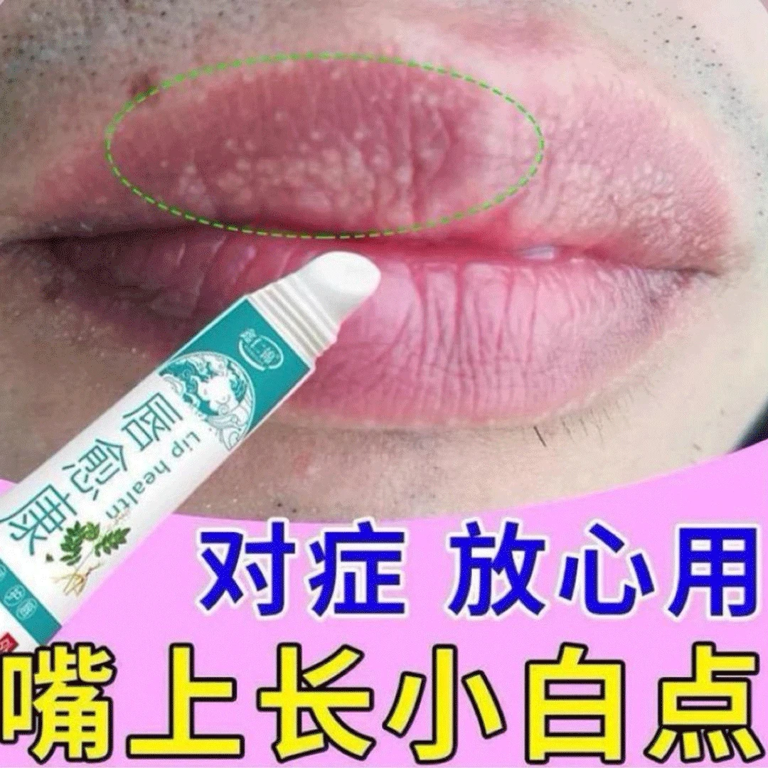 嘴上长小白点嘴角红肿干裂嘴巴起皮长小水泡嘴角白颗粒草本唇膏