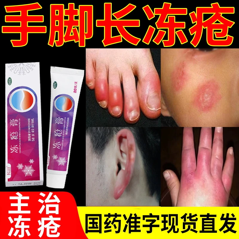 科田冻疮膏20g成人儿童冬季手脚耳朵脸部冻疮瘙痒红肿干裂药膏防冻疮止痒软膏