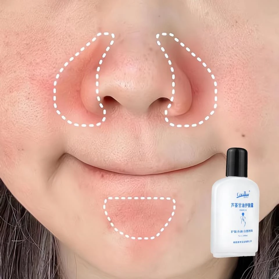 鼻子两侧干燥起皮脸上皮肤紧绷下巴红痒脱皮鼻子两侧发红芦荟甘油