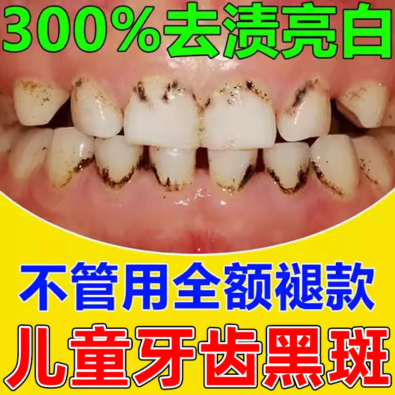 儿童去牙菌斑祛除神器去黑牙黑斑黑渍污垢清洁黄牙膏含氟美白牙齿